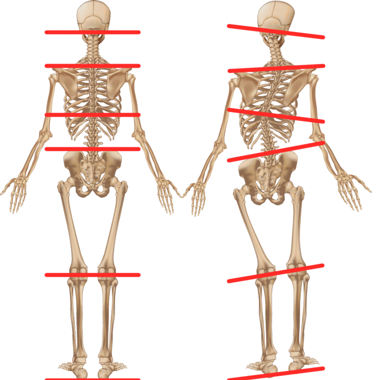 Beinlängendifferenz - Was steckt dahinter?