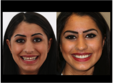 Innovative Zahnästhetik – Mit Digital Smile Design heute wissen, wie ich morgen aussehe
